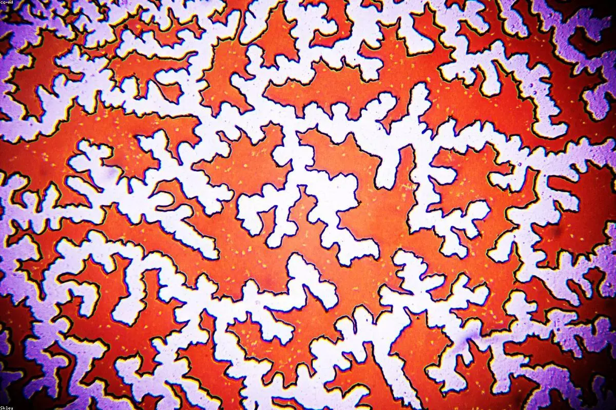 Beyond the Blood: Exploring the Surprising Link Between Anaemia and Dementia