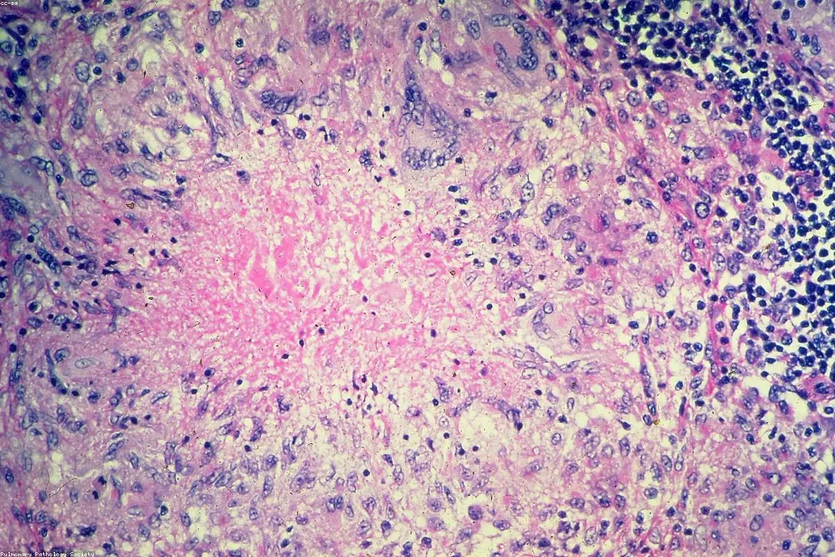 The Horrifying Reality of Flesh-Eating Bacteria: One Survivor's Battle Against a 'Roadkill' Appearance